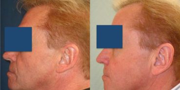 Facelift Colombia - Premium Care Plastic Surgery