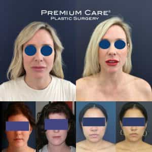 Facial Sculpting in Colombia - Before and After Facial Sculpting in Colombia - Before and After