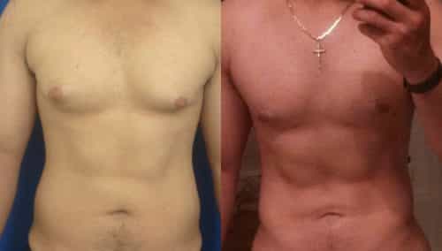 Before and After Male Breast Reduction Colombia - Premium Care Plastic Surgery