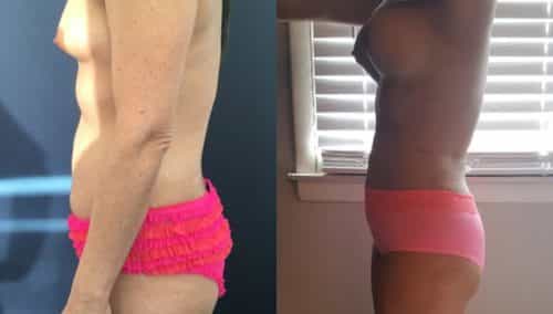 Before and after Mommy Makeover Colombia - Premium Care Plastic Surgery