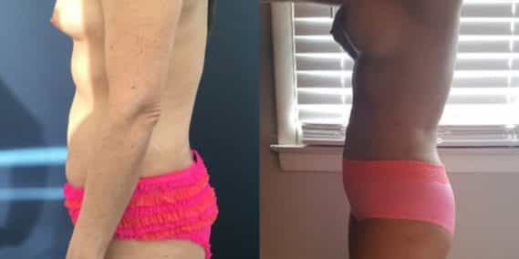 Before and after Mommy Makeover Colombia - Premium Care Plastic Surgery