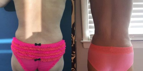 Before and after Mommy Makeover Colombia - Premium Care Plastic Surgery