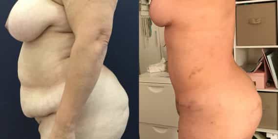 Before and after Mommy Makeover Colombia - Premium Care Plastic Surgery