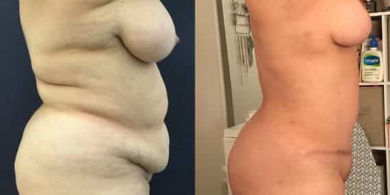 Before and after Mommy Makeover Colombia - Premium Care Plastic Surgery