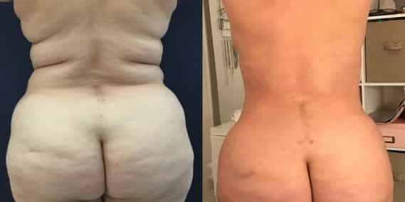 Before and after Mommy Makeover Colombia - Premium Care Plastic Surgery