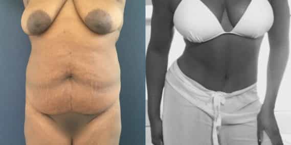Before and after Mommy Makeover Colombia - Premium Care Plastic Surgery