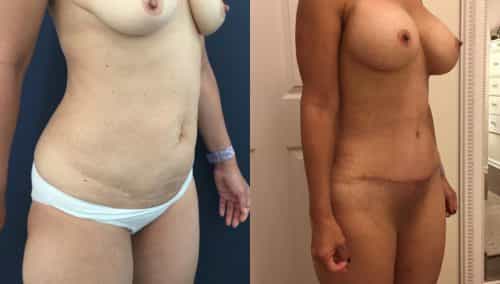 Before and after Mommy Makeover Colombia - Premium Care Plastic Surgery