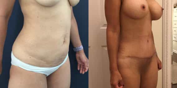 Before and after Mommy Makeover Colombia - Premium Care Plastic Surgery