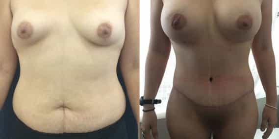 Before and after Mommy Makeover Colombia - Premium Care Plastic Surgery