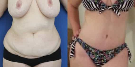 Before and after Mommy Makeover Colombia - Premium Care Plastic Surgery