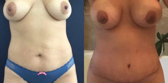 Before and after Mommy Makeover Colombia - Premium Care Plastic Surgery