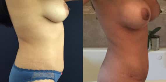Before and after Mommy Makeover Colombia - Premium Care Plastic Surgery