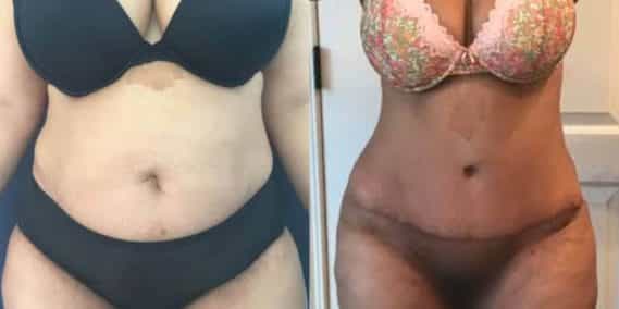 Before and after Mommy Makeover Colombia - Premium Care Plastic Surgery