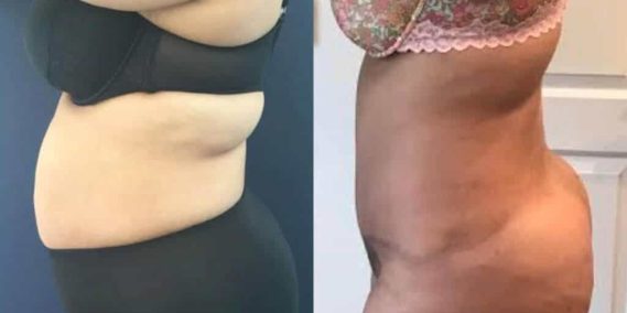 Before and after Mommy Makeover Colombia - Premium Care Plastic Surgery