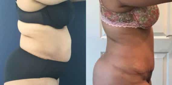 Before and after Mommy Makeover Colombia - Premium Care Plastic Surgery