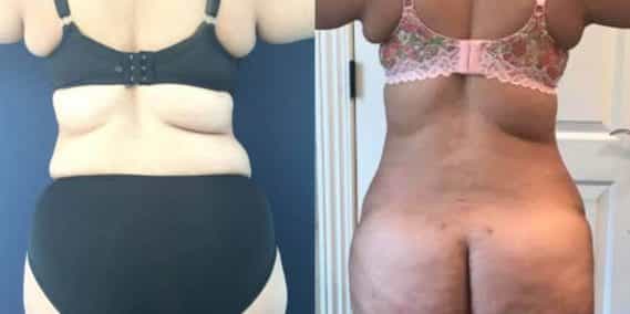 Before and after Mommy Makeover Colombia - Premium Care Plastic Surgery
