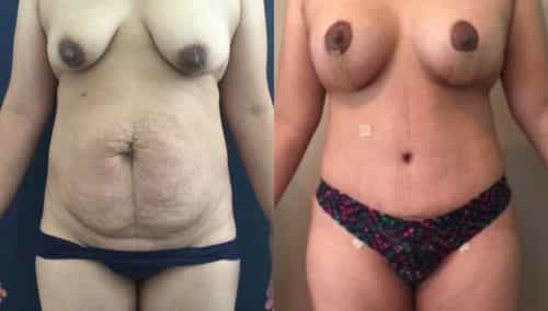 Before and after Mommy Makeover Colombia - Premium Care Plastic Surgery