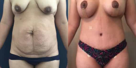 Before and after Mommy Makeover Colombia - Premium Care Plastic Surgery