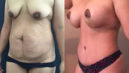 Before and after Mommy Makeover Colombia - Premium Care Plastic Surgery