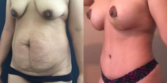 Before and after Mommy Makeover Colombia - Premium Care Plastic Surgery