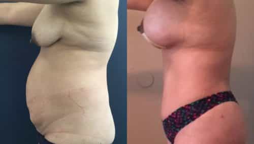 Before and after Mommy Makeover Colombia - Premium Care Plastic Surgery