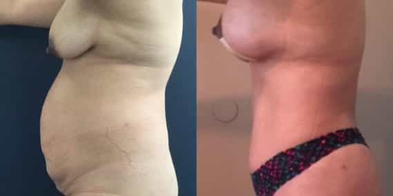 Before and after Mommy Makeover Colombia - Premium Care Plastic Surgery