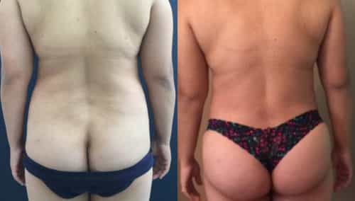 Before and after Mommy Makeover Colombia - Premium Care Plastic Surgery