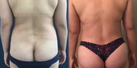Before and after Mommy Makeover Colombia - Premium Care Plastic Surgery