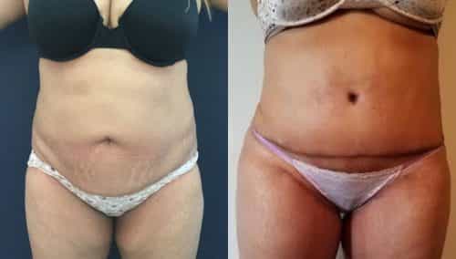 Before and after Mommy Makeover Colombia - Premium Care Plastic Surgery