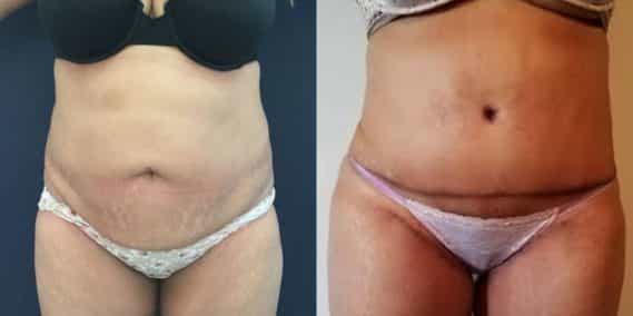 Before and after Mommy Makeover Colombia - Premium Care Plastic Surgery