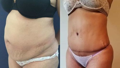 Before and after Mommy Makeover Colombia - Premium Care Plastic Surgery