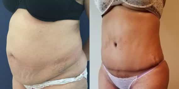 Before and after Mommy Makeover Colombia - Premium Care Plastic Surgery