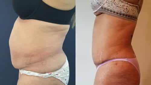 Before and after Mommy Makeover Colombia - Premium Care Plastic Surgery