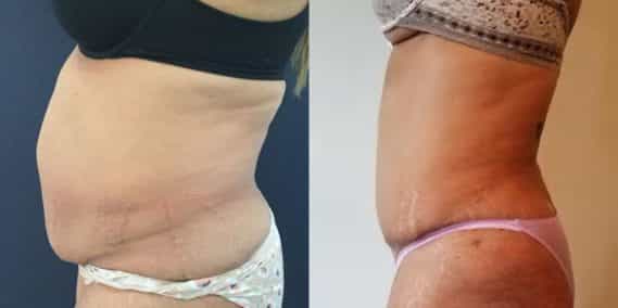 Before and after Mommy Makeover Colombia - Premium Care Plastic Surgery