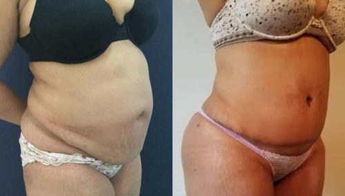 Before and after Mommy Makeover Colombia - Premium Care Plastic Surgery