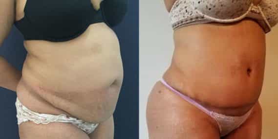 Before and after Mommy Makeover Colombia - Premium Care Plastic Surgery