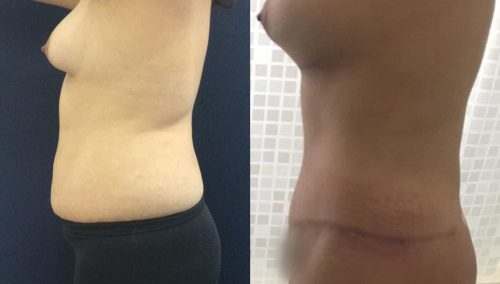 Before and after Mommy Makeover Colombia - Premium Care Plastic Surgery