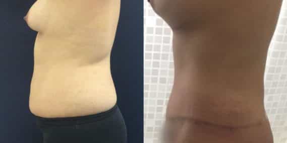 Before and after Mommy Makeover Colombia - Premium Care Plastic Surgery