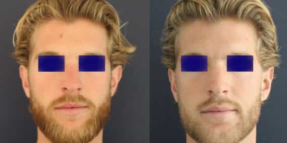 Ear Surgery Colombia - Premium Care Plastic Surgery