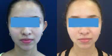 Ear Surgery Colombia - Premium Care Plastic Surgery