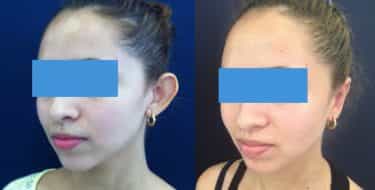 Ear Surgery Colombia - Premium Care Plastic Surgery