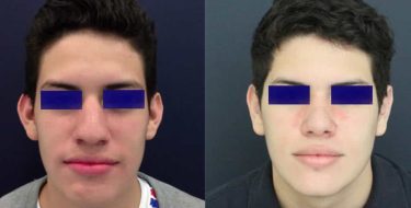Ear Surgery Colombia - Premium Care Plastic Surgery