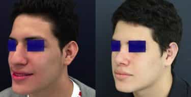 Ear Surgery Colombia - Premium Care Plastic Surgery