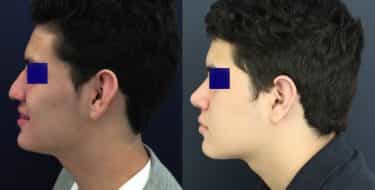 Ear Surgery Colombia - Premium Care Plastic Surgery