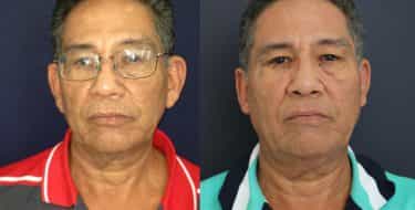 Ear Surgery Colombia - Premium Care Plastic Surgery