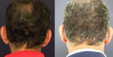 Ear Surgery Colombia - Premium Care Plastic Surgery