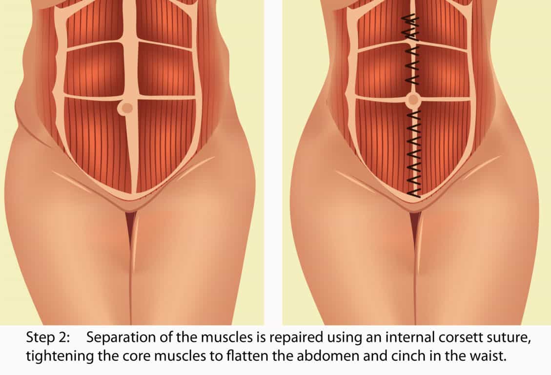 Tummy Tuck in Colombia - technique 2 Tummy Tuck in Colombia - technique 2