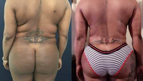 Before and After brazilian butt lift Colombia - Premium Care Plastic Surgery