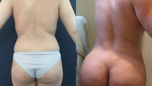 Before and After brazilian butt lift Colombia - Premium Care Plastic Surgery