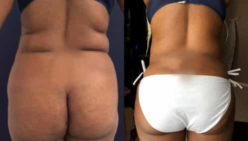 Before and After brazilian butt lift Colombia - Premium Care Plastic Surgery